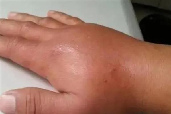 虎头蜂有没有毒，虎头蜂有毒