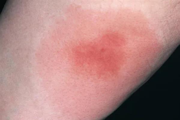 虎头蜂有没有毒，虎头蜂有毒