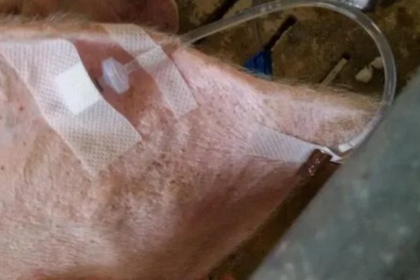 猪心肌炎怎么治疗，病毒性心肌炎可使用金刚烷胺等药物