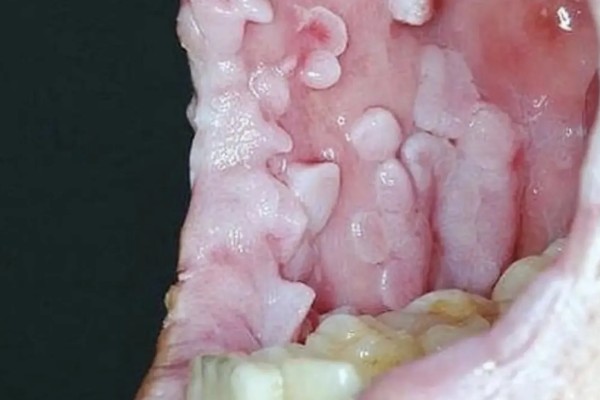 传染性口腔乳头状瘤临床症状，初期在局部出现白色隆起