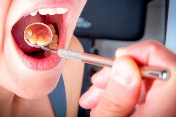 传染性口腔乳头状瘤临床症状，初期在局部出现白色隆起