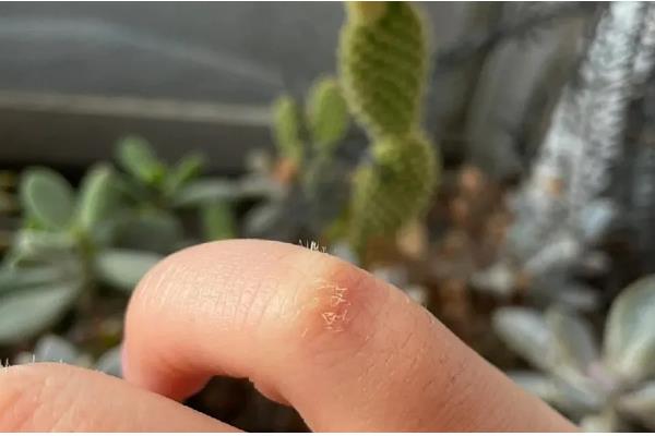 被仙人掌扎了怎么处理,一定不要揉搓