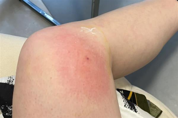 被马蜂蛰了怎么处理,及时拔除毒刺