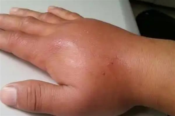 被马蜂蛰了怎么处理,及时拔除毒刺