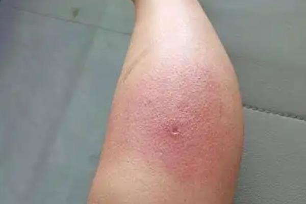被马蜂蛰后过多久会恢复,因品种和个人体质而异